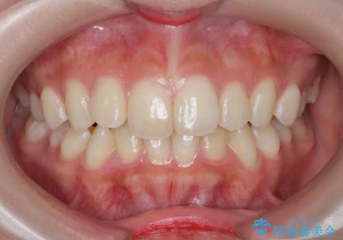 [ インビザラインライト ]   短期間で前歯だけを並べたいの症例 治療前