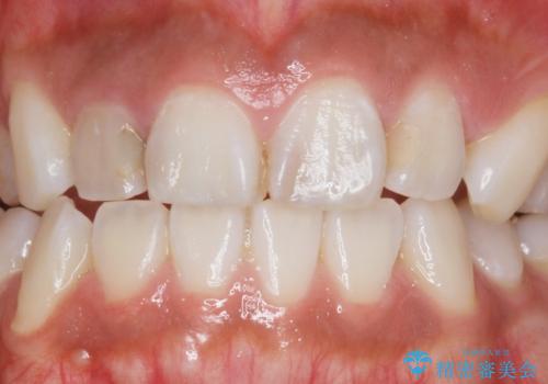 前歯の色と隙間が気になる　早く治したい　矯正は嫌　30代女性の症例 治療前