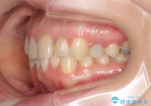 【モニター】前歯のデコボコと奥歯の虫歯　インビザライン治療と奥歯のセラミック治療の治療前