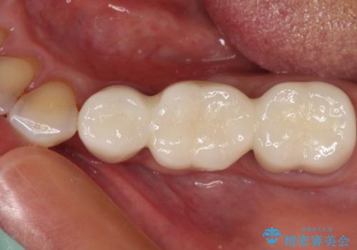 抜かずに保存した奥歯が痛くて臭う　セラミックブリッジによる欠損補綴治療の治療後