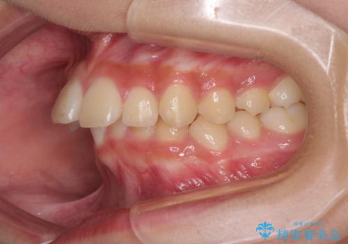 下の前歯が隠れてしまうほど深い咬み合わせ　高校生のインビザライン矯正治療の治療前