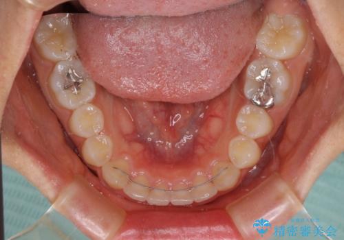 前歯のデコボコと突出感　インビザラインによる矯正治療の治療後