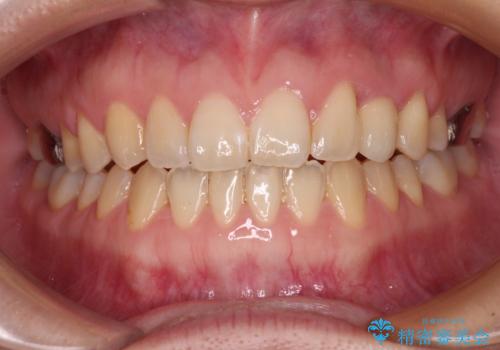 前歯インプラントの症例 治療後