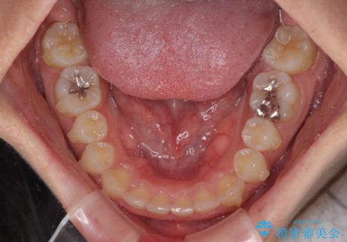 前歯のデコボコと突出感　インビザラインによる矯正治療の治療中