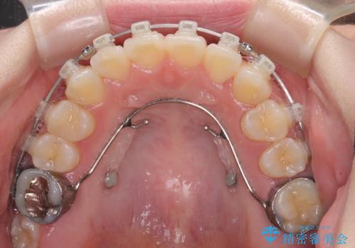 奥歯の欠損を放置　大臼歯を抜歯した矯正治療の治療中