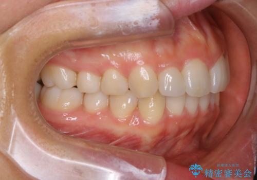 矮小歯を綺麗な歯に。矯正とセラミックの総合治療の治療後
