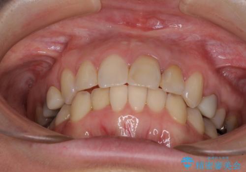 【モニター】前歯のデコボコと奥歯の虫歯　インビザライン治療と奥歯のセラミック治療の治療中