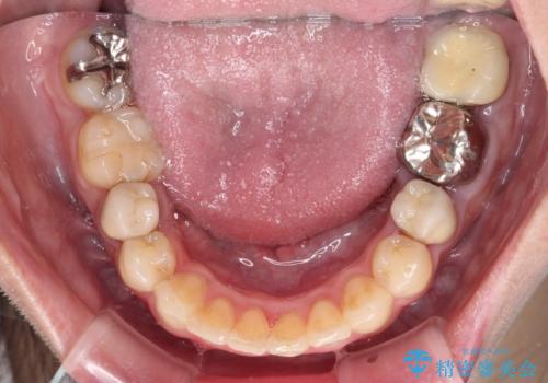目立つ銀歯を白くしたい　奥歯のセラミック治療の治療前