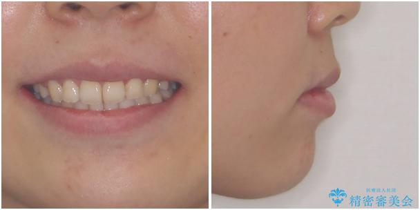 前歯の出っ歯と口の閉じにくさを抜歯矯正で改善　目立たないワイヤー矯正の治療後（顔貌）
