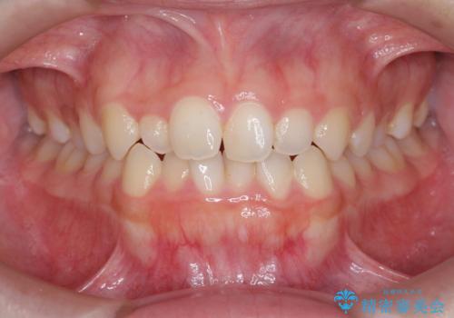 前歯のガタつき・ねじれを治すマウスピース矯正の症例 治療前