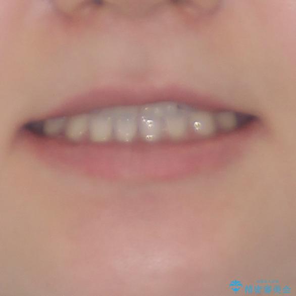 奥歯の欠損を放置　大臼歯を抜歯した矯正治療の治療後（顔貌）