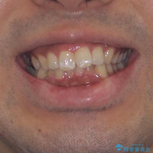 インビザラインによる矯正治療と、折れてしまった歯のインプラント補綴治療の治療前（顔貌）
