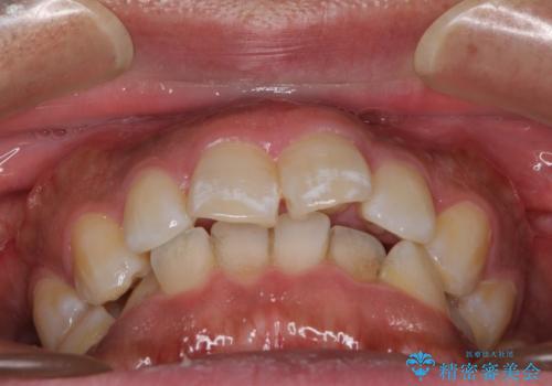 インビザラインによる矯正治療と、折れてしまった歯のインプラント補綴治療の治療前