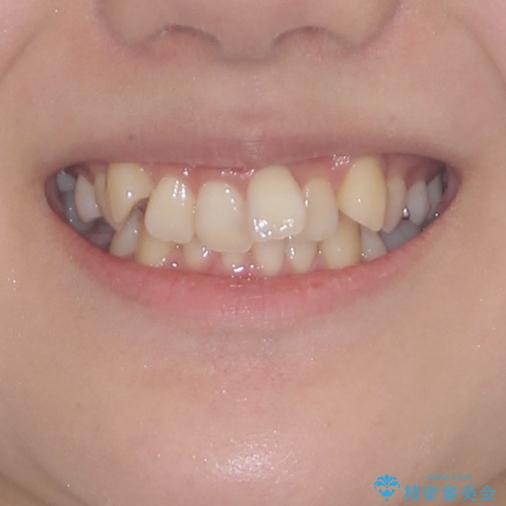 前歯の歯並びを治したい　ワイヤー装置での抜歯矯正の治療前（顔貌）
