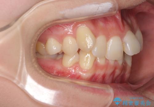 前歯の歯並びを治したい　ワイヤー装置での抜歯矯正の治療前