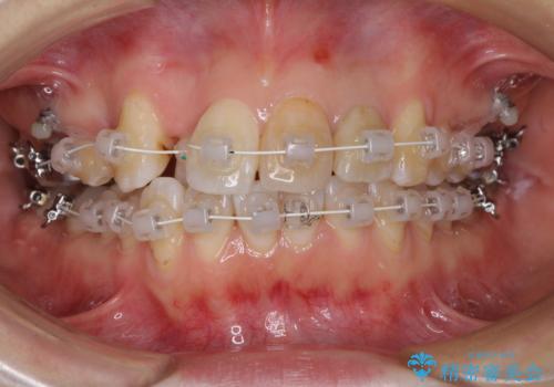 内側にある歯が邪魔　重なった前歯の歯列矯正の治療中
