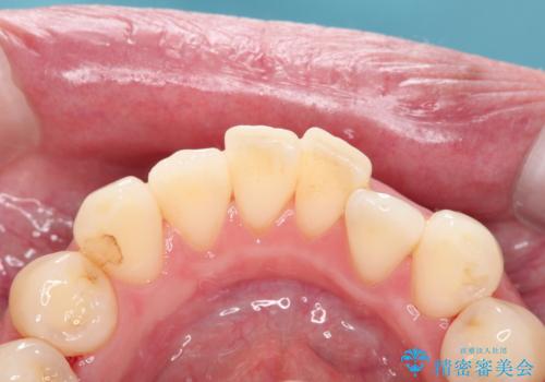 歯周病治療　歯科衛生士による歯石除去の治療後