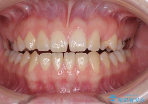 前歯インプラントの症例 治療前