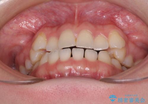奥歯の欠損を放置　大臼歯を抜歯した矯正治療の治療前