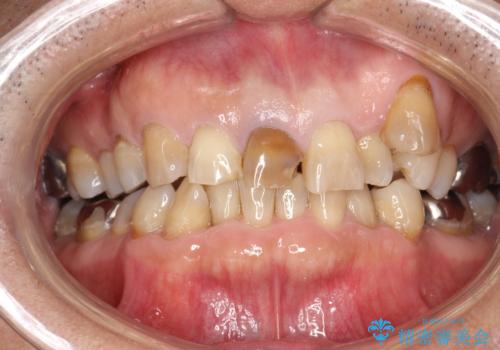 セラミックによる前歯の変色の改善の症例 治療前