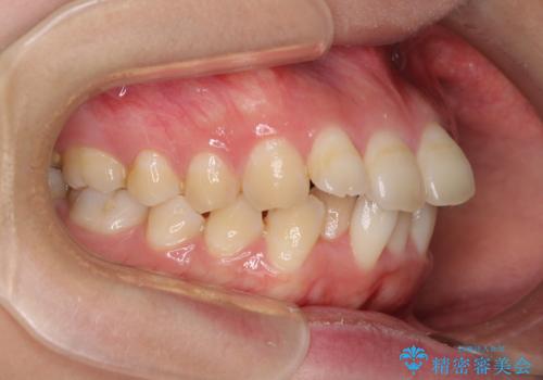 前歯の出っ歯と口の閉じにくさを抜歯矯正で改善　目立たないワイヤー矯正の治療前