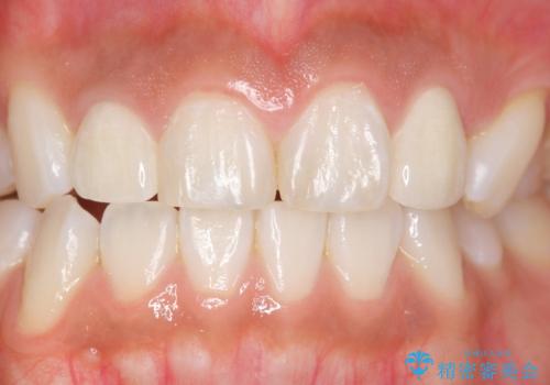 前歯の色と隙間が気になる　早く治したい　矯正は嫌　30代女性の症例 治療後