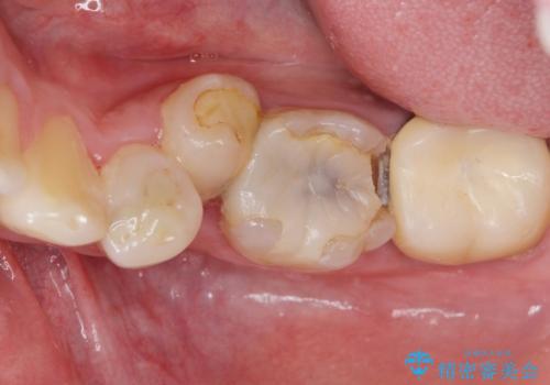 内側に生えている歯をなんとかしたい　矯正は嫌　30代男性の症例 治療前