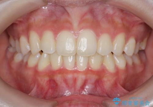 [ インビザラインライト ]   短期間で前歯だけを並べたいの症例 治療後