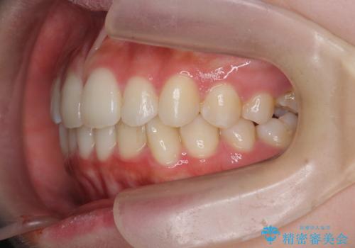 [ インビザラインライト ]   短期間で前歯だけを並べたいの治療後