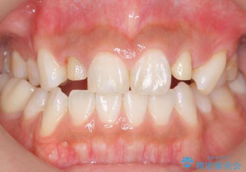 前歯の色と隙間が気になる　早く治したい　矯正は嫌　30代女性の治療中