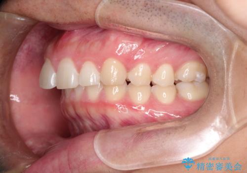 出っ歯が気になる　インビザラインによる出っ歯の目立たない矯正の症例 治療前
