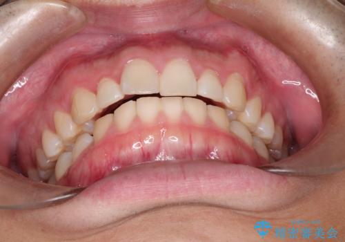 出っ歯が気になる　インビザラインによる出っ歯の目立たない矯正の治療前