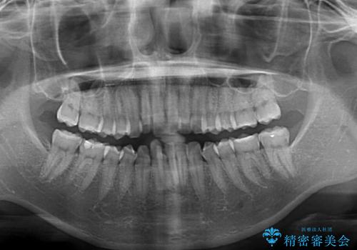 前歯の出っ歯と口の閉じにくさを抜歯矯正で改善　目立たないワイヤー矯正の治療前
