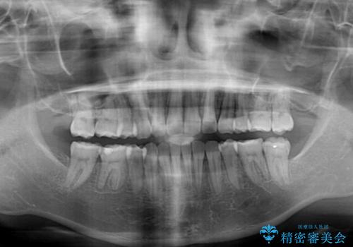 前歯の出っ歯と口の閉じにくさを抜歯矯正で改善　目立たないワイヤー矯正の治療後