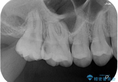 他院で入れたインレーの下にむし歯、ゴールドインレーで修復の治療前