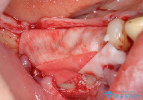 薄い骨幅　骨造成　歯肉移植を併用したインプラント治療の治療前