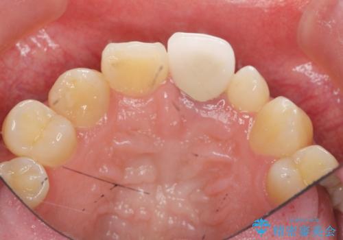 [ 前歯セラミック治療 ]白く不自然な前歯をきれいにしたいの治療前