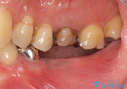 臼歯部インプラント・再補綴の治療前