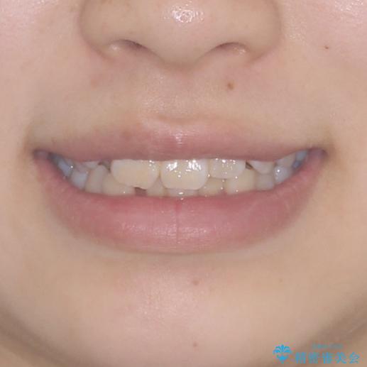 八重歯で正中が右にずれている　ワイヤー装置での抜歯矯正で正中位置を改善の治療前（顔貌）