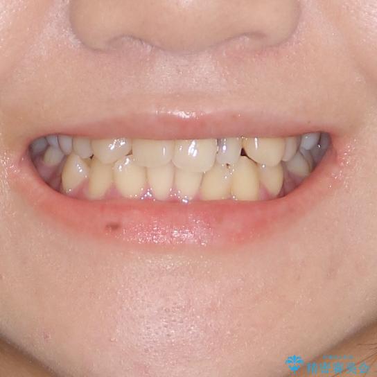 八重歯の抜歯矯正　補助装置を用いたインビザライン矯正の治療前（顔貌）