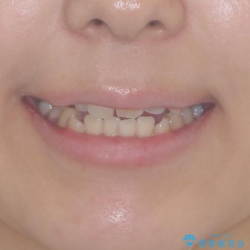 補助装置を使ったインビザラインによる抜歯矯正の治療前（顔貌）