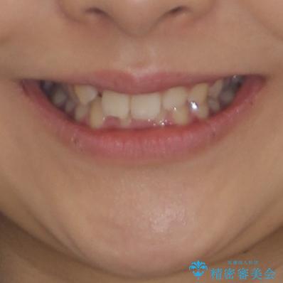 気になる八重歯を改善　補助装置併用のインビザライン治療の治療前（顔貌）