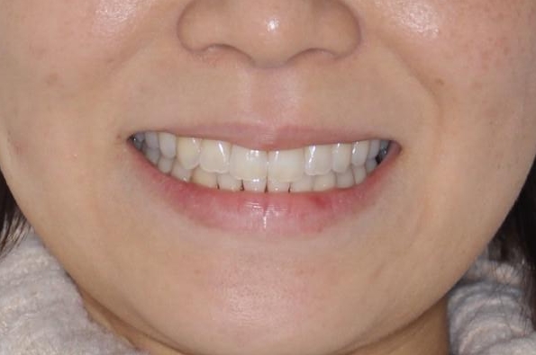 【インビザライン】前歯の凸凹をなおしたいの治療後（顔貌）
