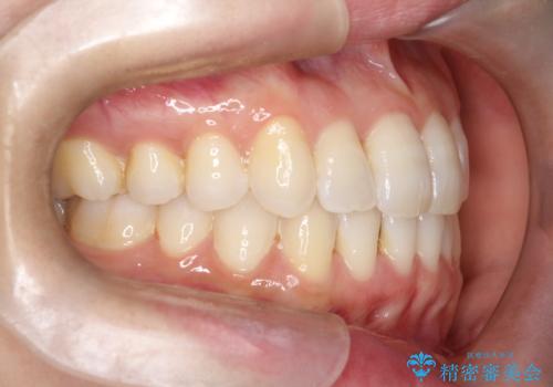 【インビザライン】前歯の凸凹をなおしたいの治療後