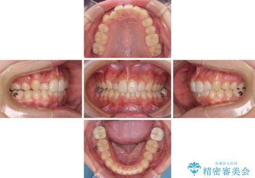 気になる八重歯を改善　補助装置併用のインビザライン治療の治療中
