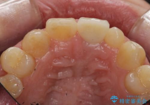 [ 前歯セラミック治療 ]白く不自然な前歯をきれいにしたいの治療後