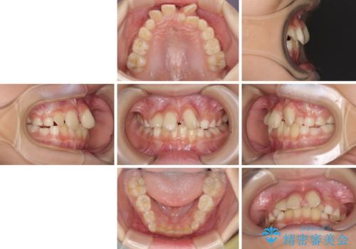 過剰歯を抜歯して前歯を排列　インビザライン・ファーストによる小学生のⅠ期治療の治療前