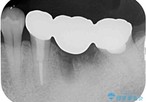 痛む奥歯と見栄えの悪い前歯　オールセラミックによる補綴治療の治療後