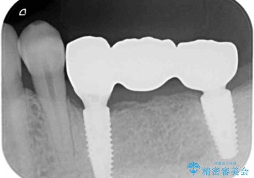臼歯部インプラント・再補綴の治療後