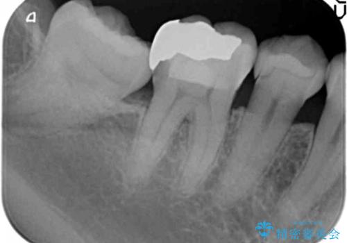 詰め物の下が虫歯　つぎはぎの歯をしっかり治療の治療前